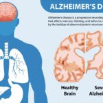 Alzheimer’s disease treatment in Gurgaon