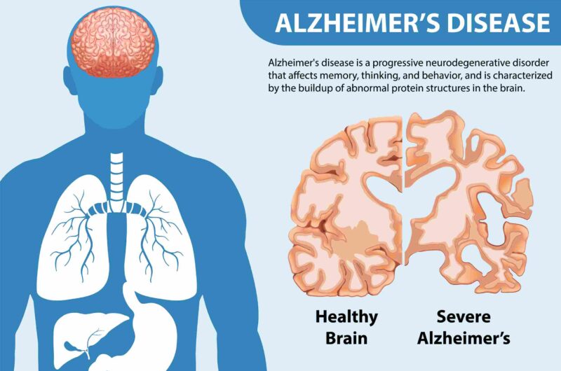 Alzheimer’s disease treatment in Gurgaon