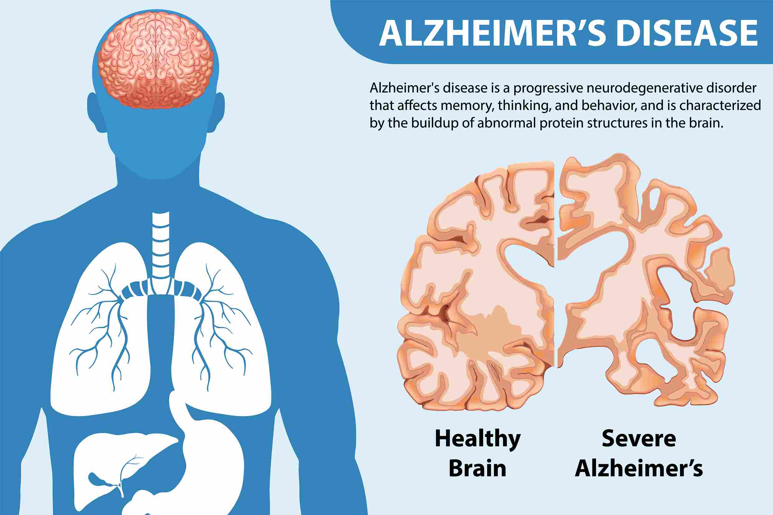 Alzheimer’s Disease Treatment in Gurgaon, India